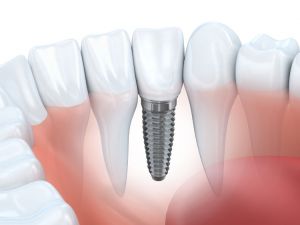 best-tooth-pain-dentist-los-angeles-doctor-dr-farshad-labib-dds-services-dental-implants-750x563